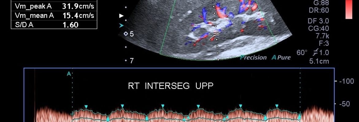 AORTOARTERITIS WITH B/L RAS – Case By Dr. Nitin Jadhav