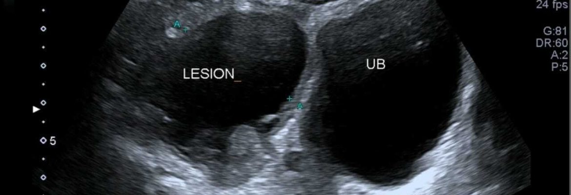 DIVERTICULITIS – Case By Dr. Nitin Jadhav