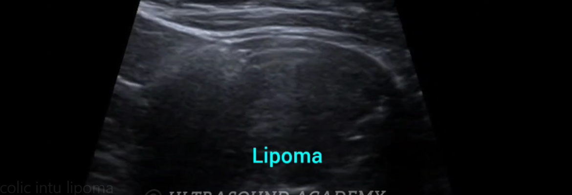 COLO-COLIC INTUSSUSCEPTION WITH LIPOMA – Case By Dr. Nitin Jadhav