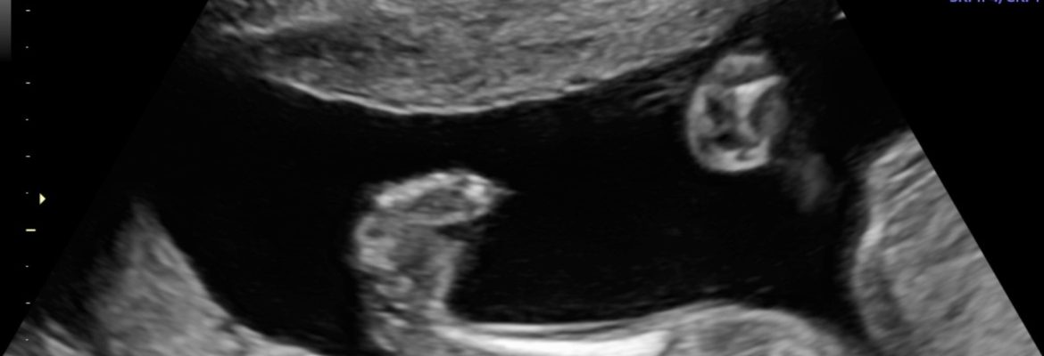 BILATERAL CONGENITAL TALIPES EQUINOVARUS – Case By Dr. Nitin Jadhav