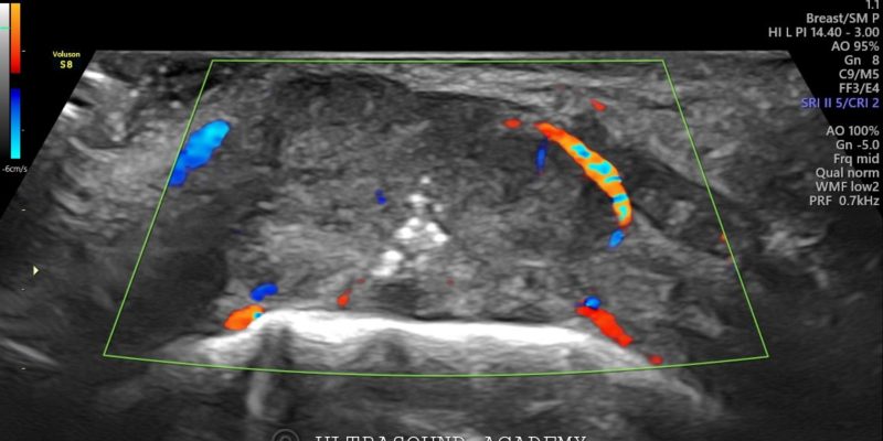 BUCCAL MUCOSA CARCINOMA – Case By Dr. Nitin Jadhav