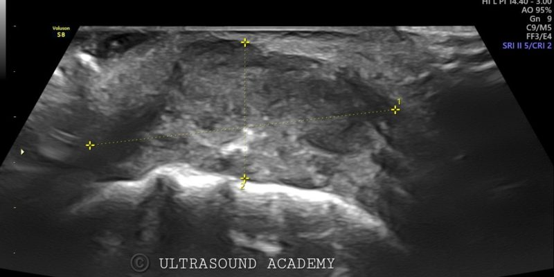 BUCCAL MUCOSA CARCINOMA – Case By Dr. Nitin Jadhav