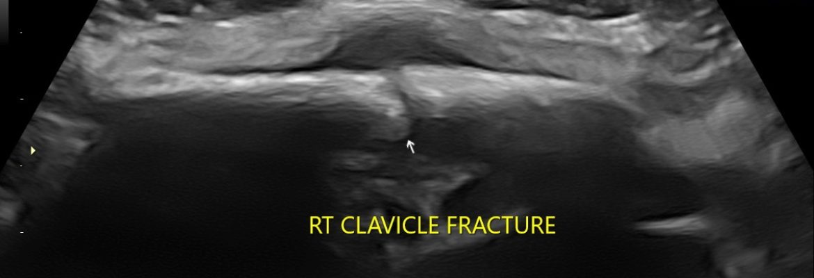 CLAVICLE FRACTURE CHILD – Case By Dr. Nitin Jadhav