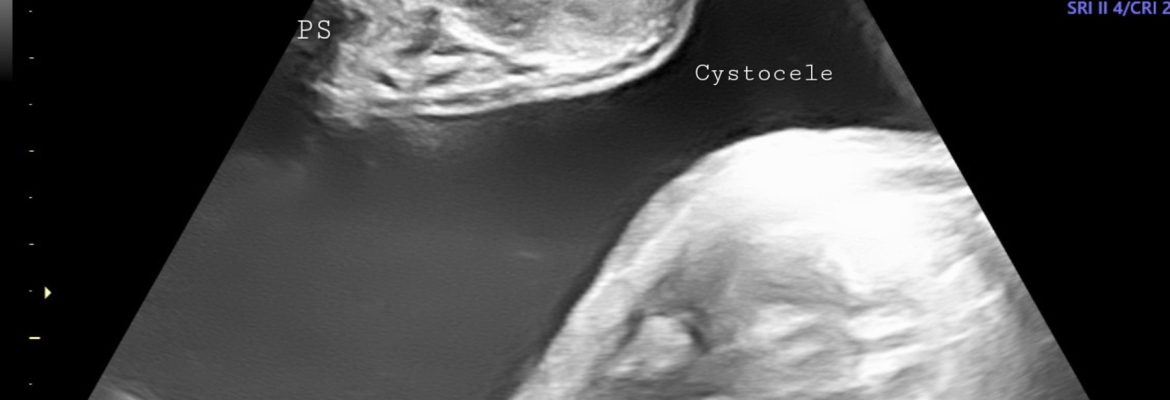 CYSTOCELE TRANSPERINEAL – Case By Dr. Nitin Jadhav