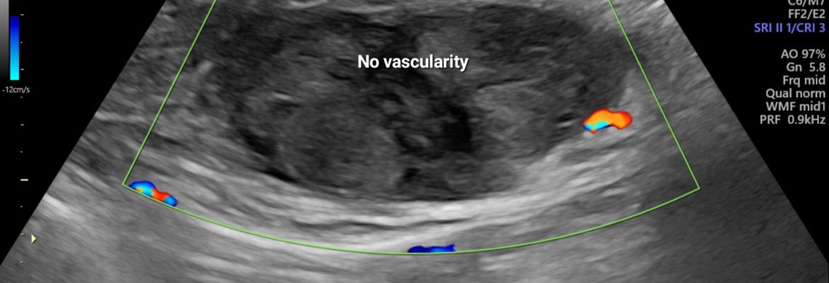 ACUTE RECTUS HEMATOMA – Case By Dr. Nitin Jadhav