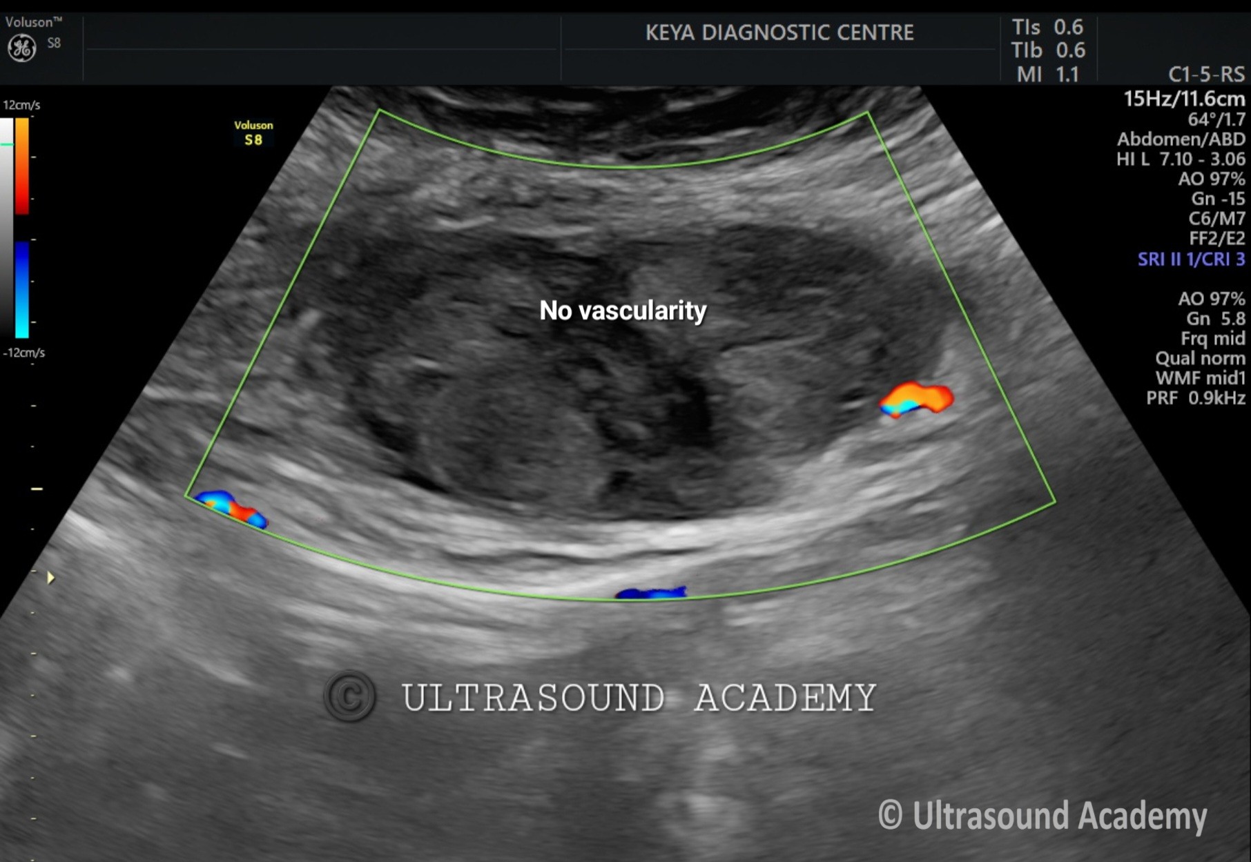 ACUTE RECTUS HEMATOMA Case By Dr Nitin Jadhav ACUTE RECTUS HEMATOMA Case By Dr Nitin Jadhav
