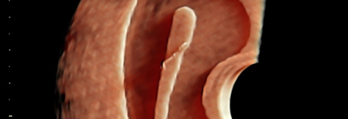 ASHERMAN SYNDROME – Case By Dr. Nitin Jadhav