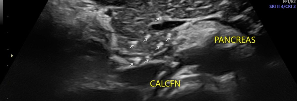CHRONIC PANCREATITIS IN CHILD – Case By Dr. Nitin Jadhav