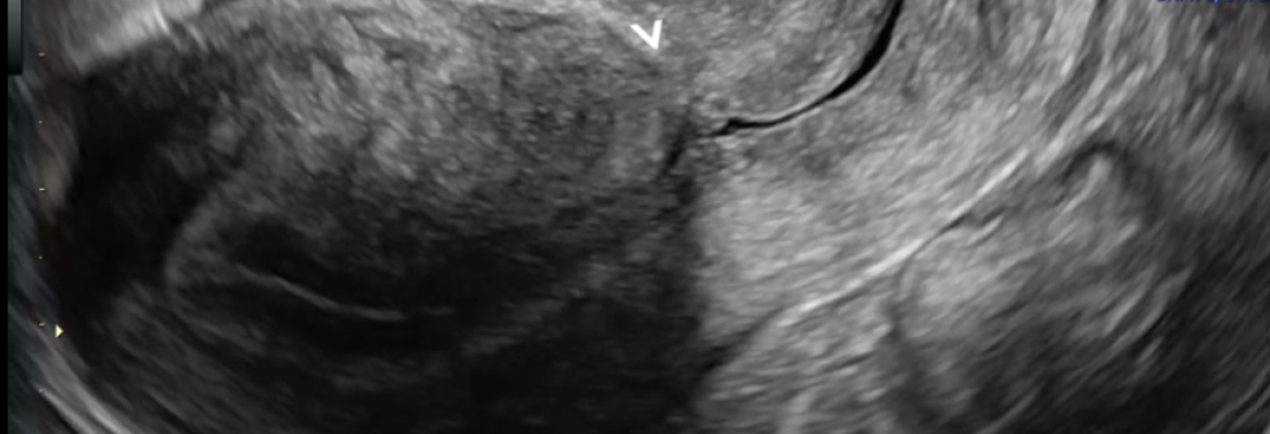 NORMAL LSCS SCAR – Case By Dr. Nitin Jadhav