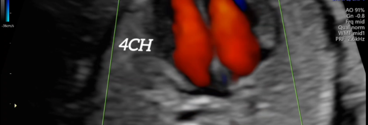 NORMAL FETAL HEART 21 WEEKS ON COLOUR DOPPLER – Case By Dr. Nitin Jadhav