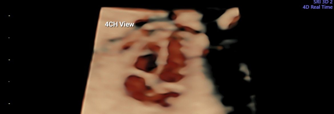 NORMAL 4D FETAL HEART– Case By Dr. Nitin Jadhav