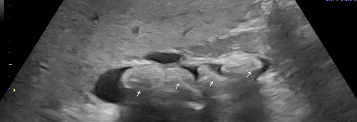 CHOLEDOCHOLITHIASIS  – Case By Dr. Nitin Jadhav