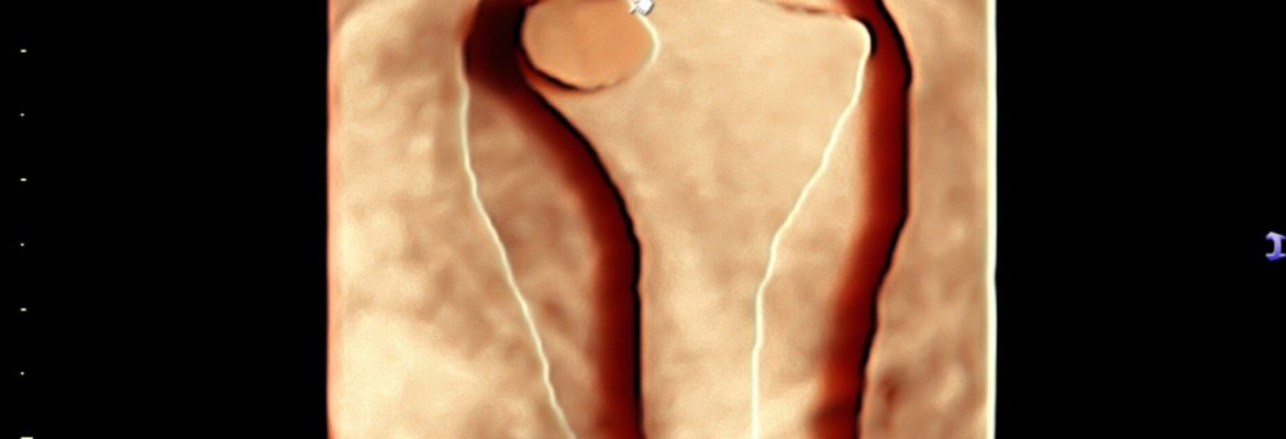 ENDOMETRIAL POLYP 3D – Case By Dr. Nitin Jadhav