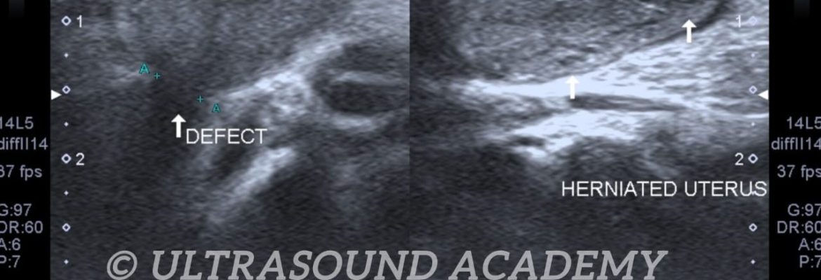 UTERINE INGUINAL HERNIA – Case By Dr. Nitin Jadhav