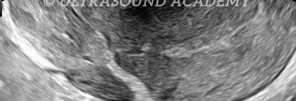 ACUTE UTERINE PERFORATION – Case By Dr. Nitin Jadhav