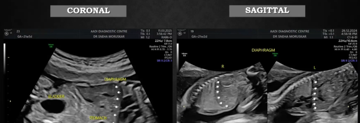 CONGENITAL DIAPHRAGMATIC HERNIA-Case presentation by fellow:- Dr. Sneha Mote