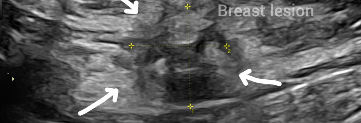 BIRADS 5 – Case By Dr. Nitin Jadhav