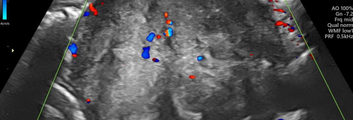 ABDOMINAL ROUND CELL TUMOUR – Case By Dr. Nitin Jadhav