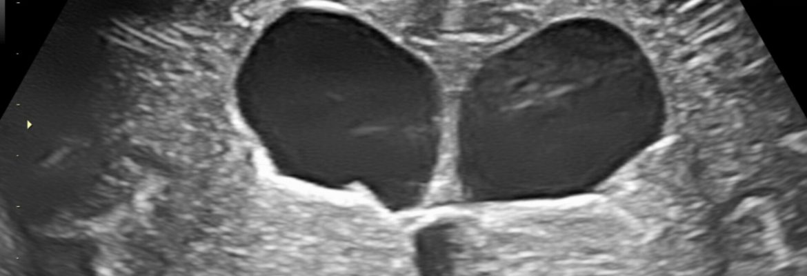 AQUEDUCTAL STENOSIS – Case By Dr. Nitin Jadhav
